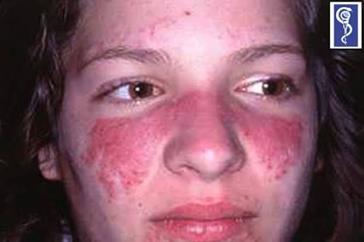 Lupus eritematoso, por deposito de complejos inmunes, eritema en alas de mariposa